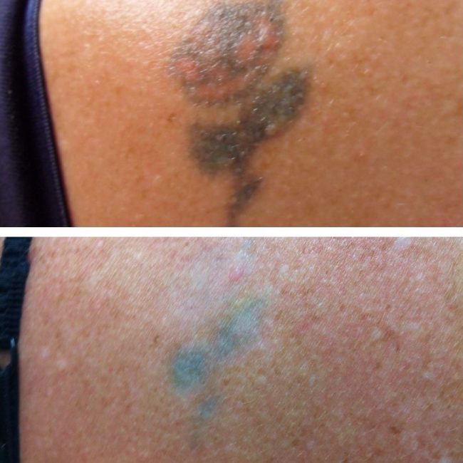 Tattoo Removal Pictures - Revive Cosmetic and Skin Clinic Logan, Brisbane